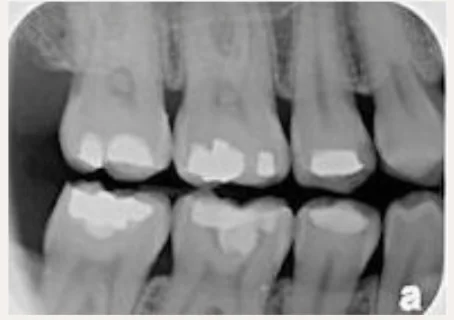 Radiografía bite-wing de dientes posteriores